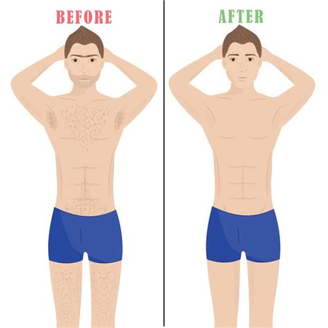 male brazilian laser hair removal near me